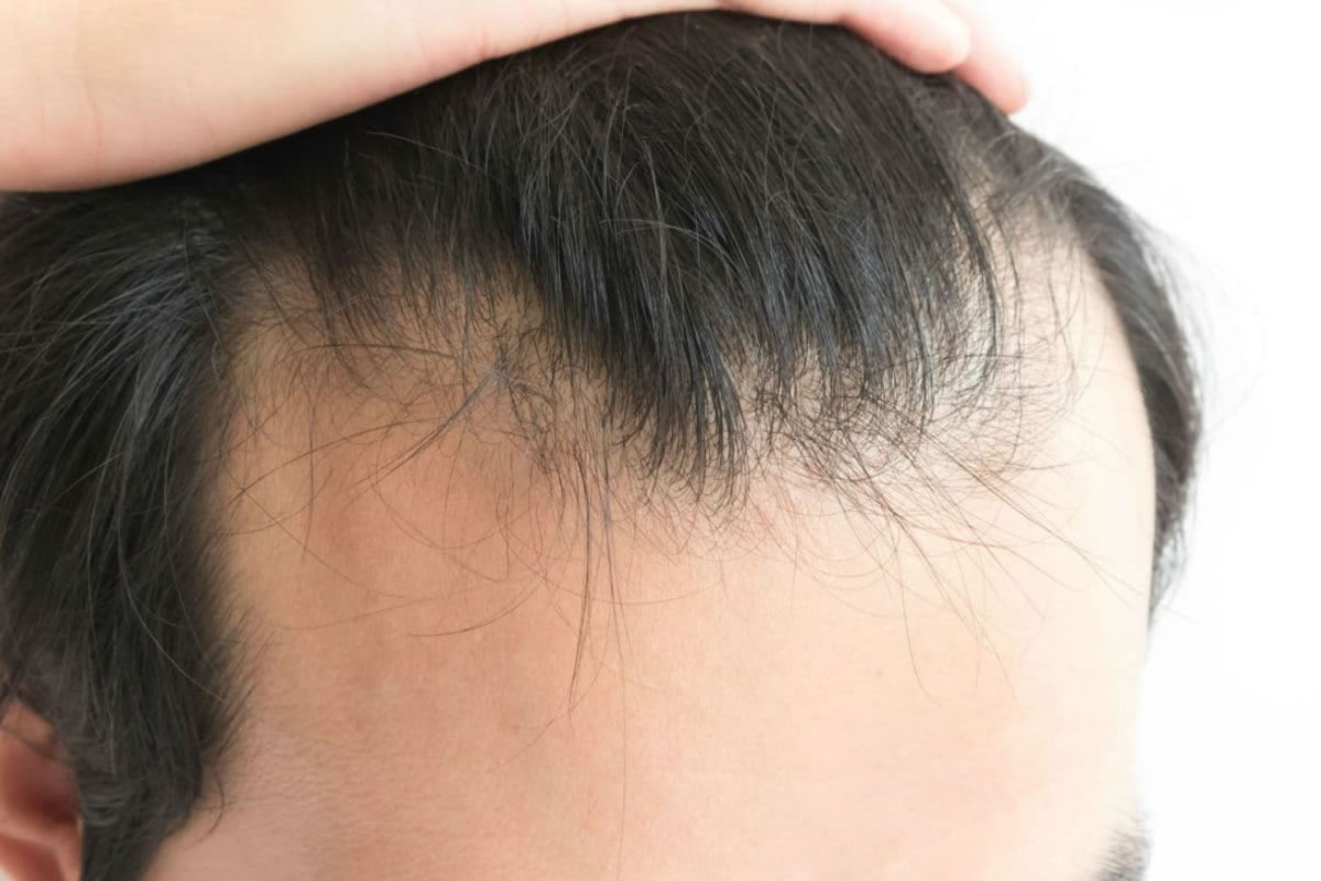 Alopecia androgénica