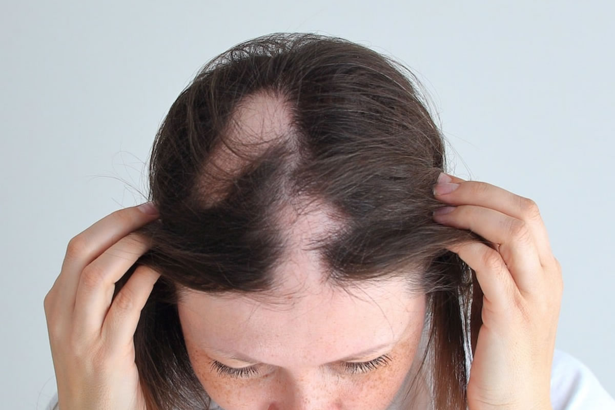 Alopecia areata